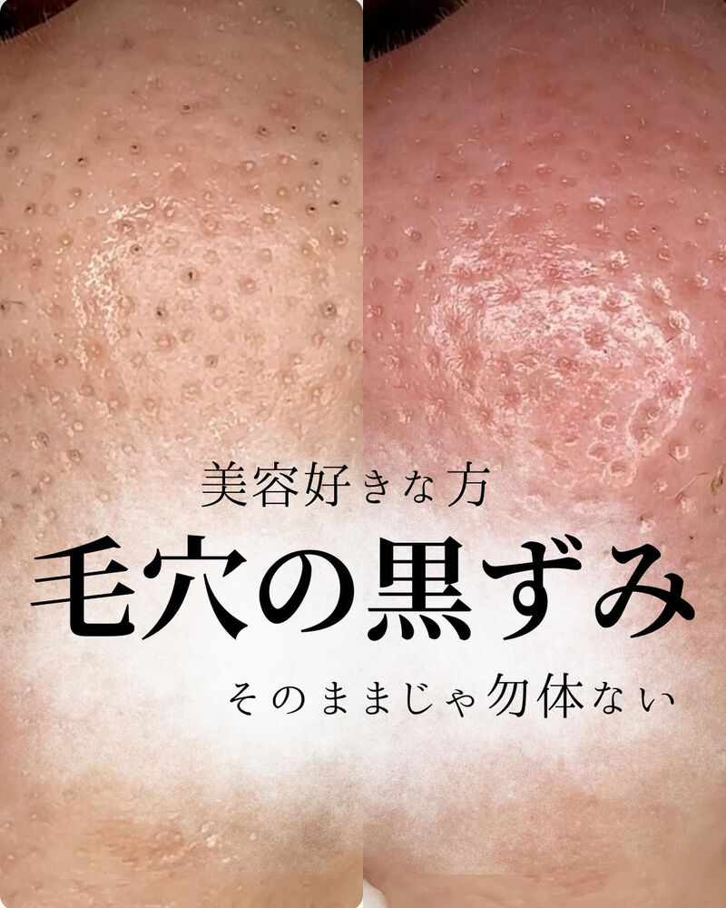 ブログ